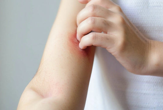 How to Get Rid of Eczema? Effective Relief with Baoshutang Bao Fu Ling