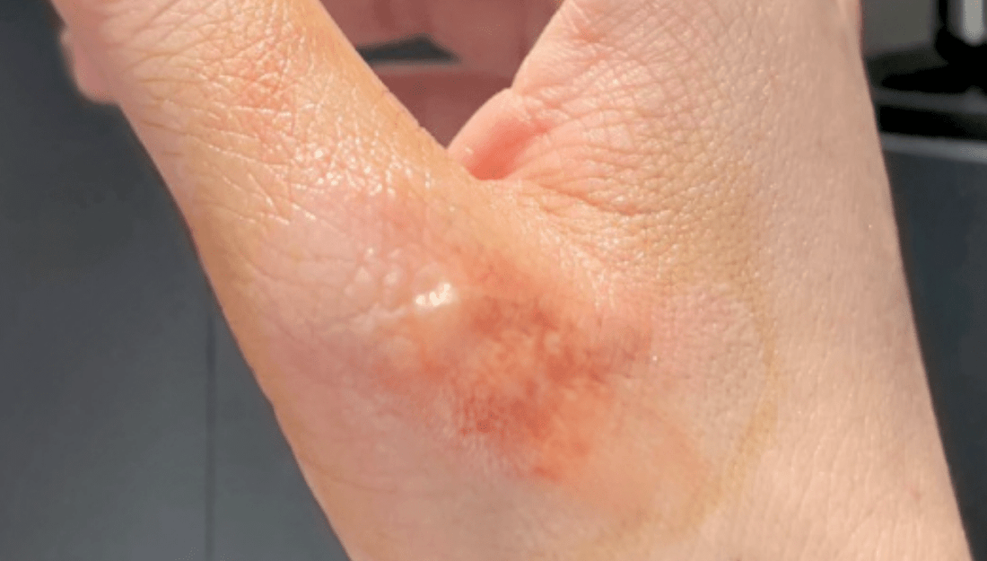Detailed Explanation of Baoshutang Baofuling® Benefits: Comprehensive Skin Care for Post-Burn Recovery - BaoFuLing Online Store
