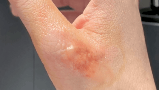 Detailed Explanation of Baoshutang Baofuling® Benefits: Comprehensive Skin Care for Post-Burn Recovery - BaoFuLing Online Store